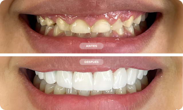 Gingivectomía