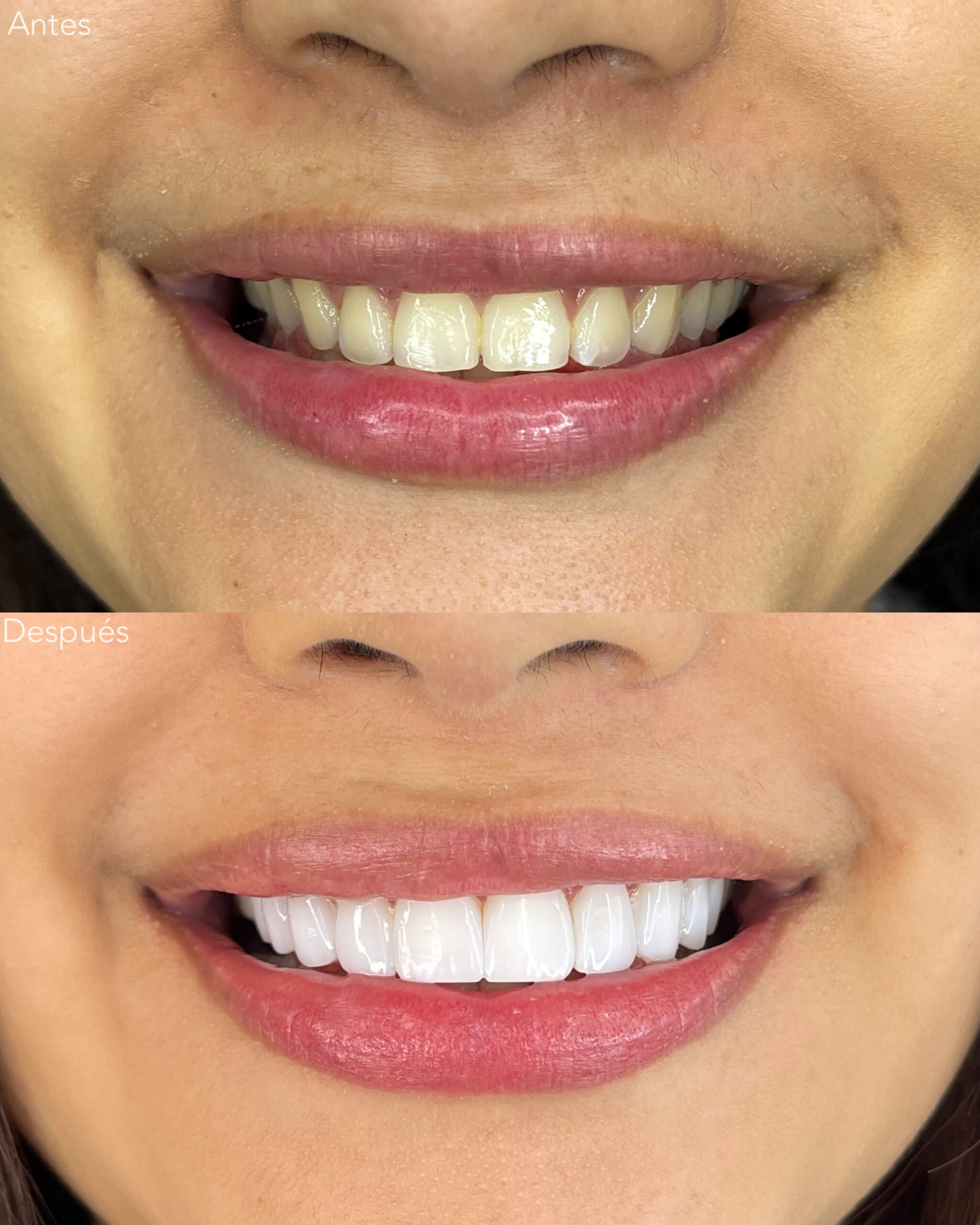 Diseño de Sonrisa