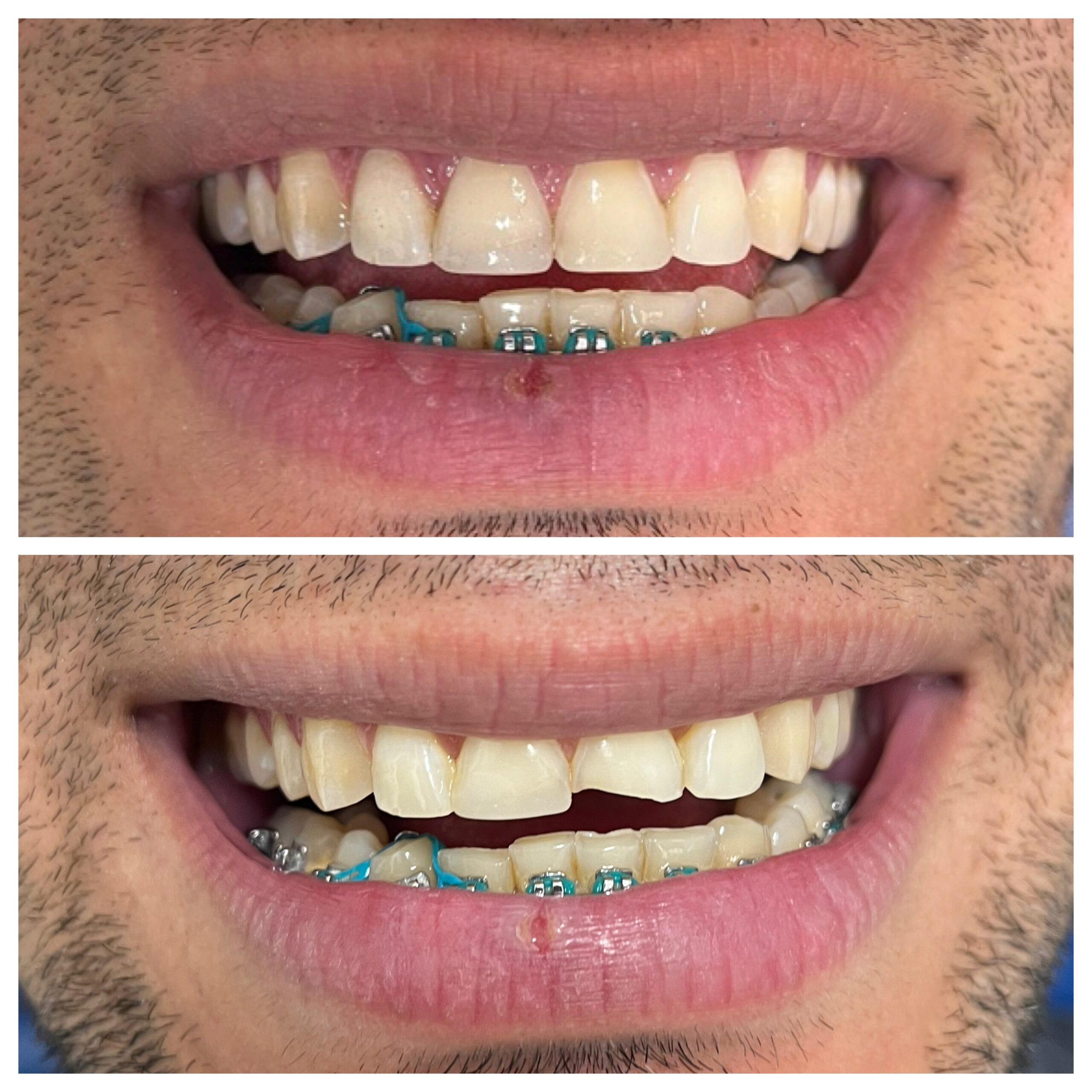 Restauración Dental