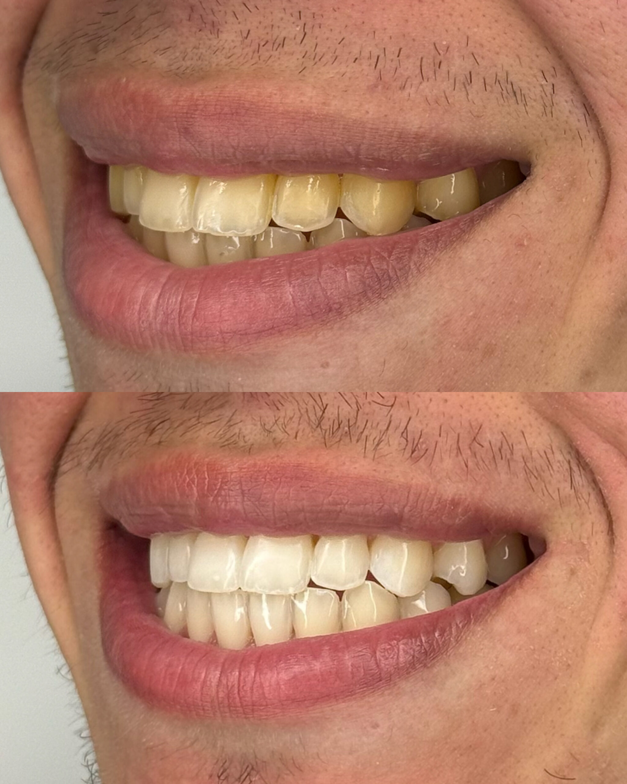 Blanqueamiento Dental