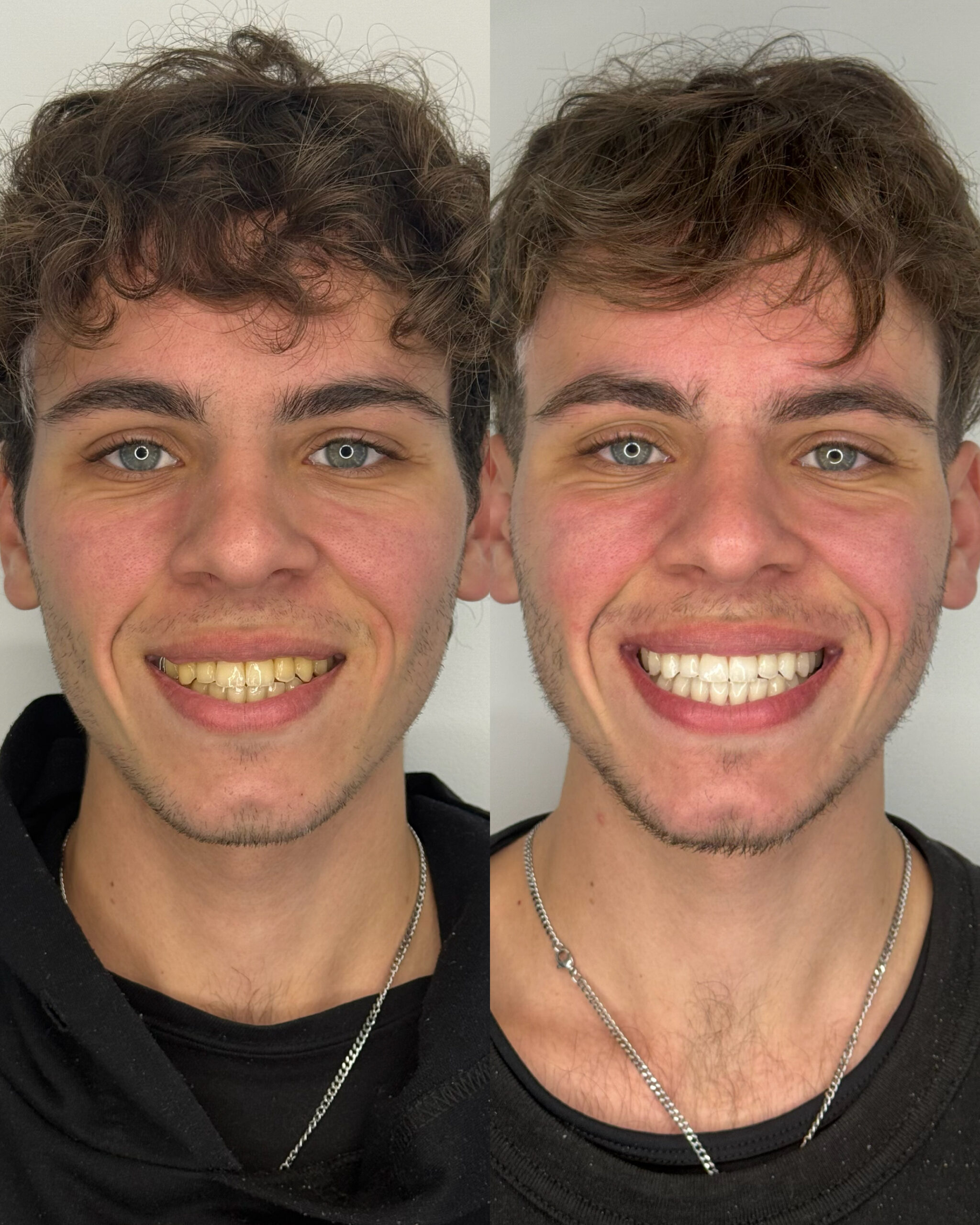 Blanqueamiento Dental